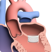 TMVR intervention workflow