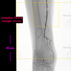 Marking thrombotic and stenotic areas within the panorama using EndoNaut PAD interface.