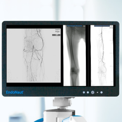 2D panoramic view of lower limb arteries generated by EndoNaut PAD for comprehensive navigation.