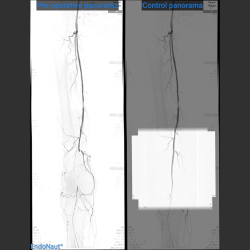 Comparative pre and postoperative panoramic views in EndoNaut PAD.