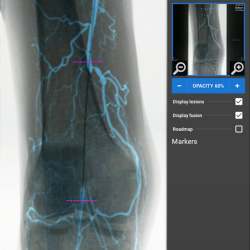 High-quality 2D image fusion achieved through AI-based algorithms in EndoNaut PAD.