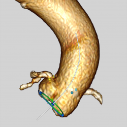 Visualization of the aortic valve segmentation.