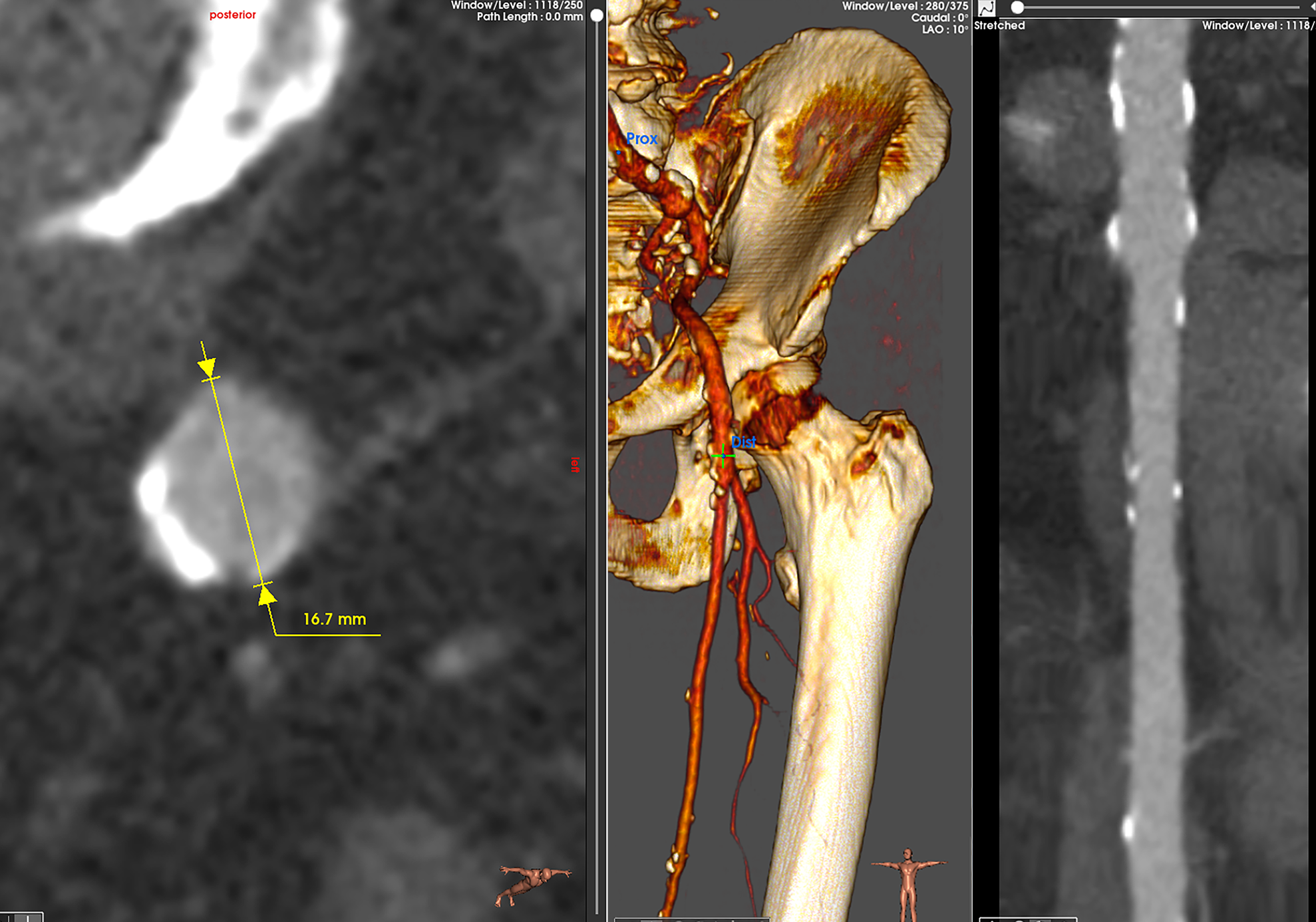 PAD stent sizing interface