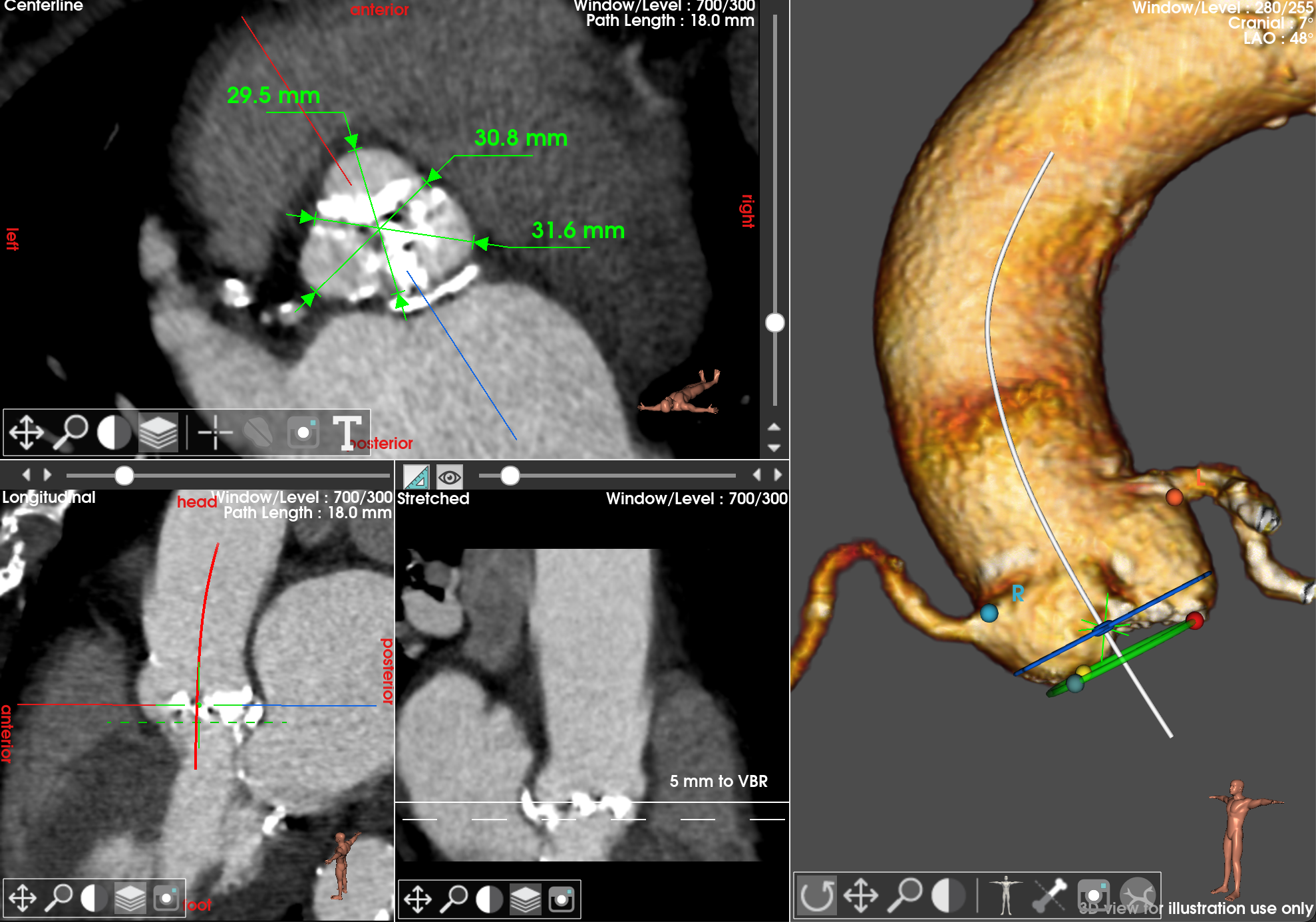 TAVI sizing interface