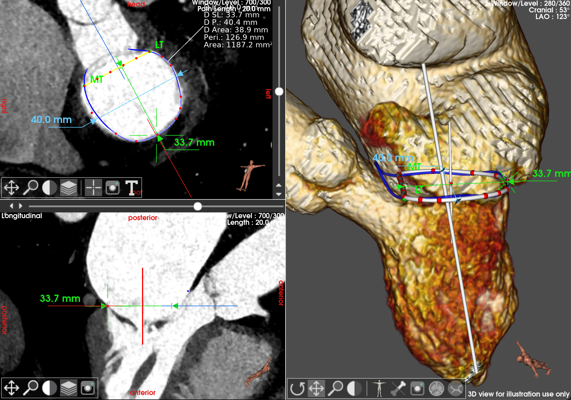 TMVR sizing interface