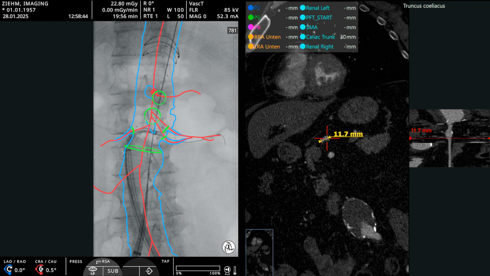 Image Fusion and measurements on Ziehm C-arm screen.
