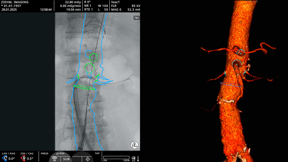 Image Fusion on Ziehm C-arm screen displayed.