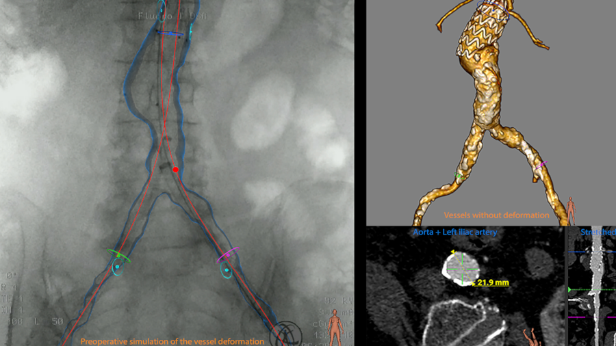 3D image fusion displayed for EVAR procedure navigation.