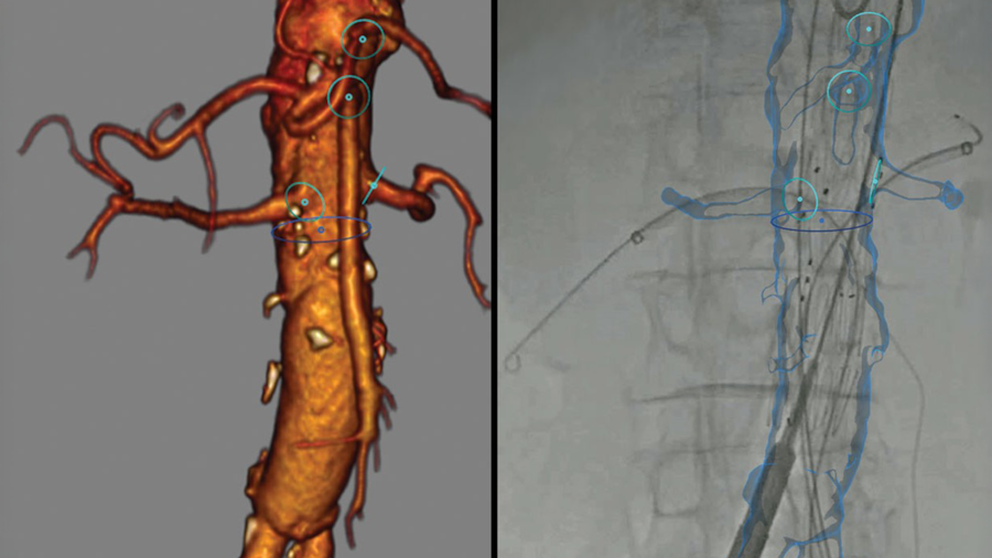 3D image fusion for fenestrated EVAR procedure navigation displayed.