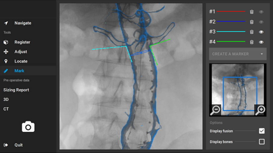 EndoNaut touchscreen interface for fenestrated EVAR procedure navigation.
