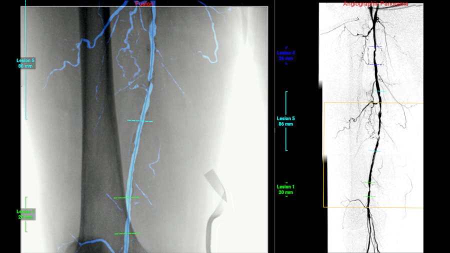 Image fusion displayed for PAD procedure navigation.